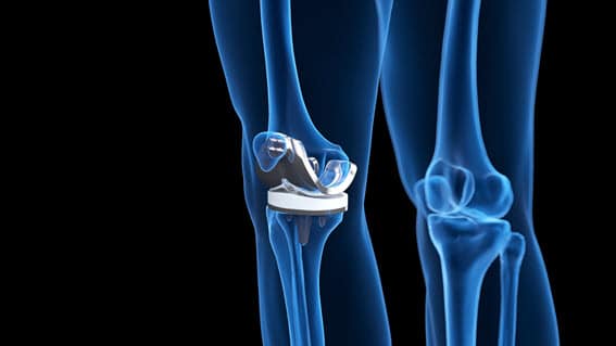 Defective Medical Device Lawyers Ohio